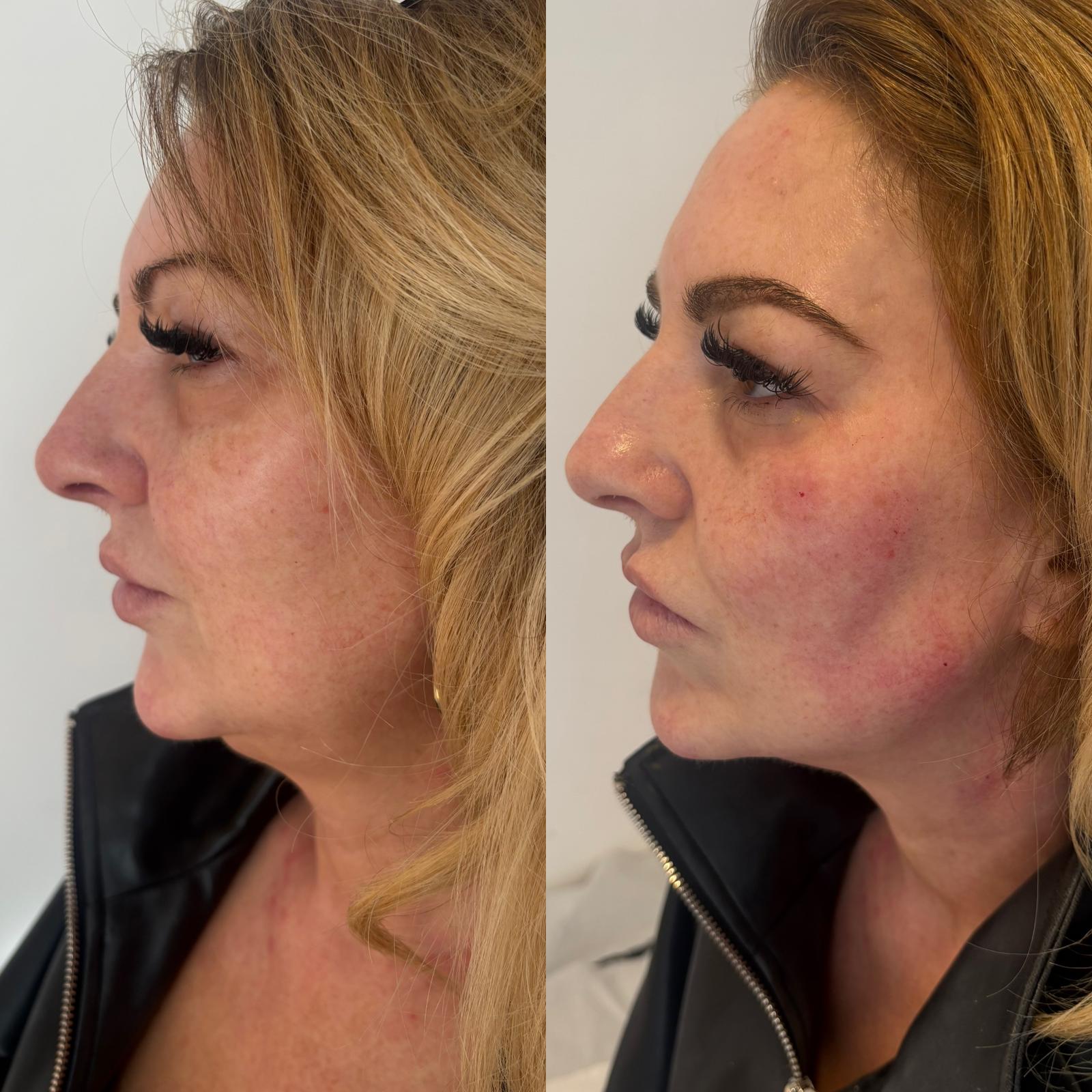 Jawline & Jowls — before and after Endolift
