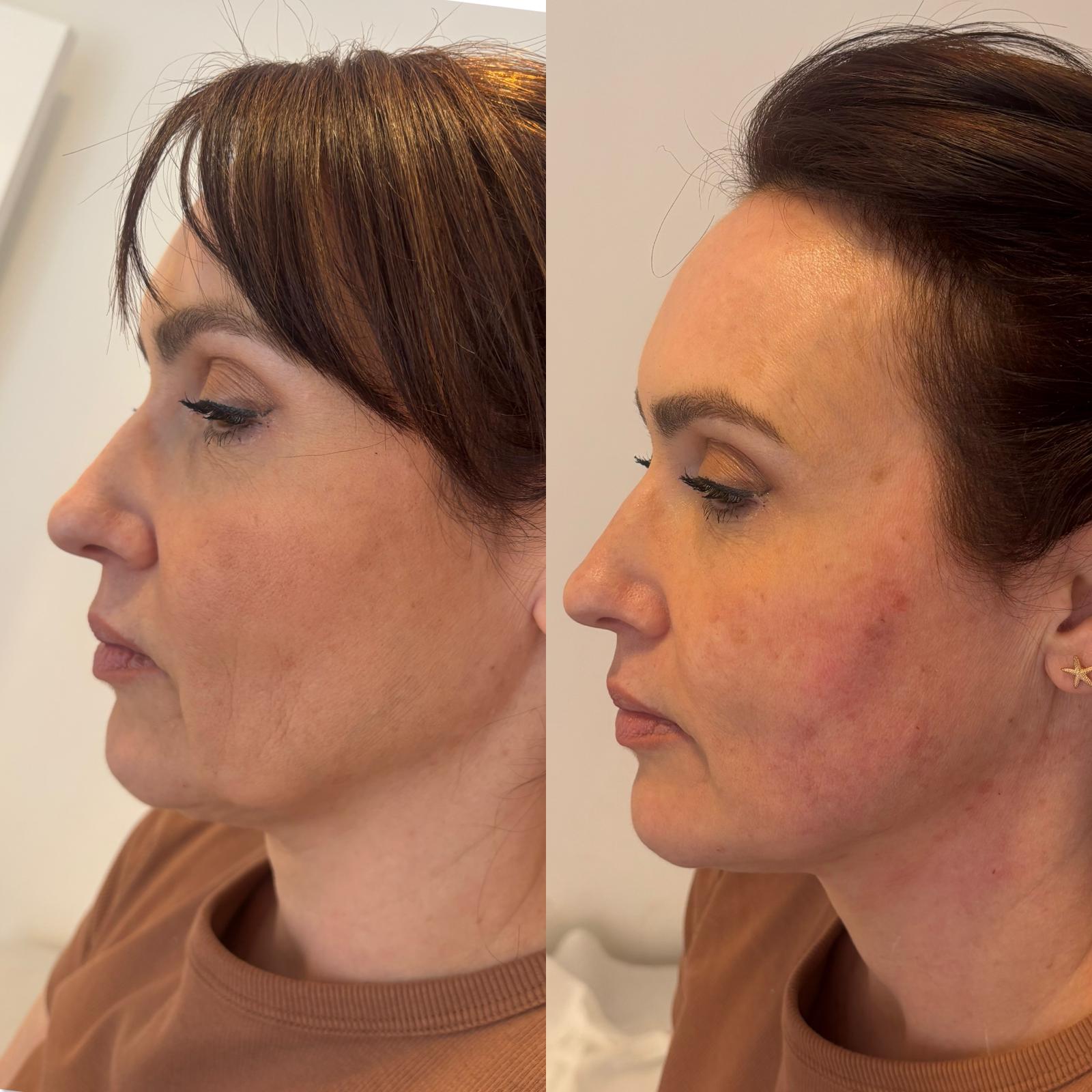 Jawline & Jowls — before and after Endolift