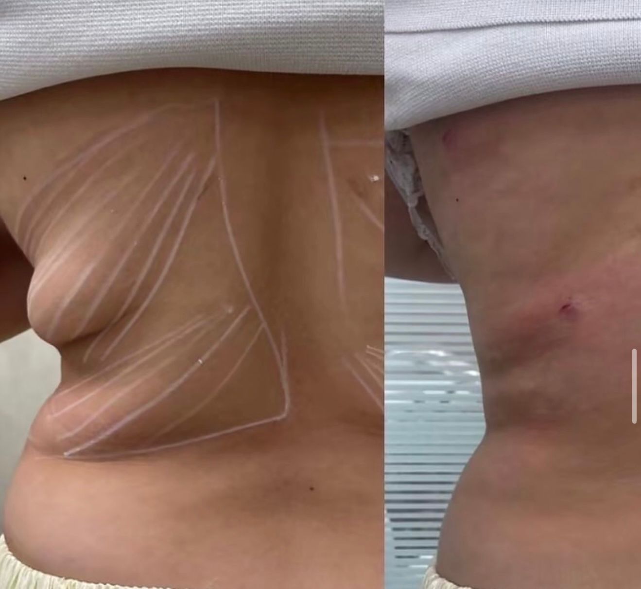 Back — before and after Endolift