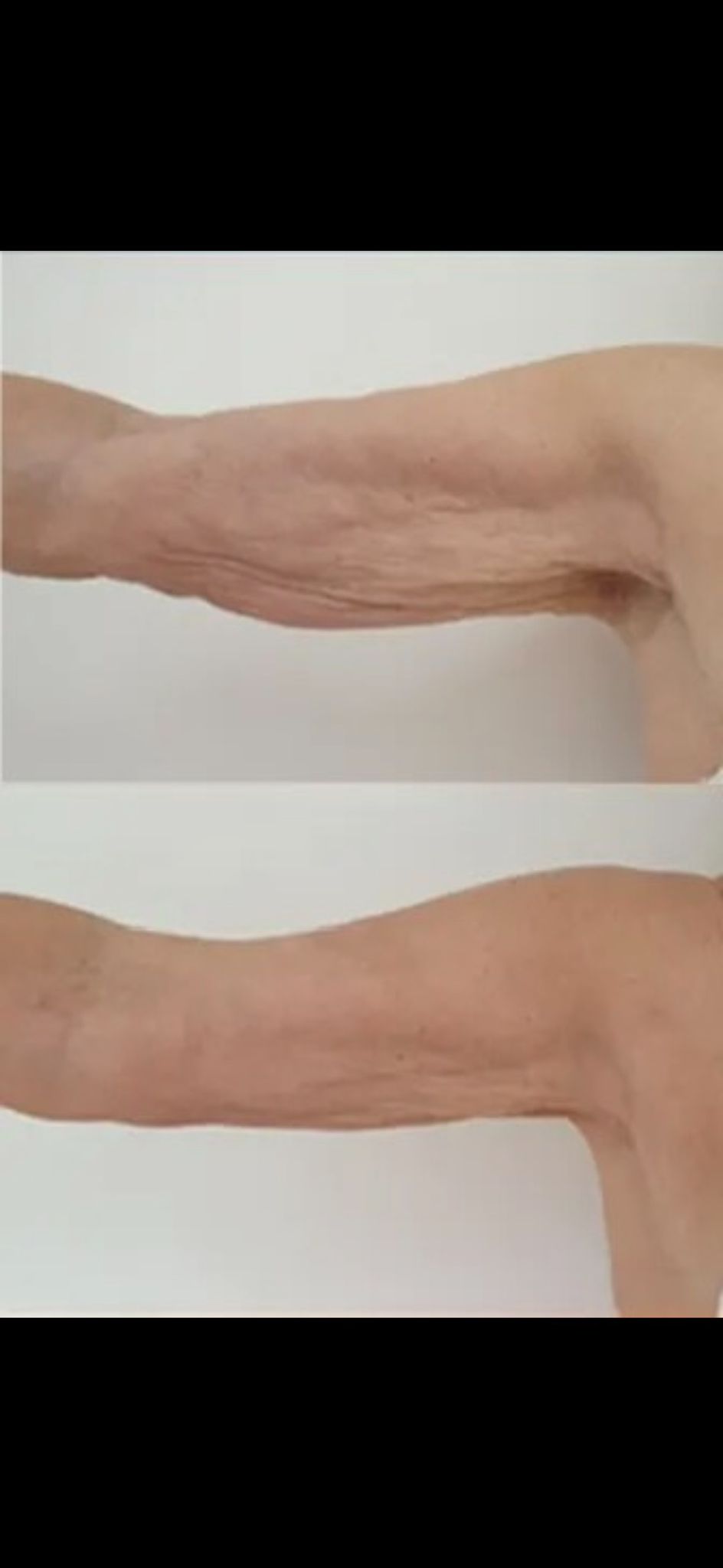 Bingo Wings — before and after Endolift
