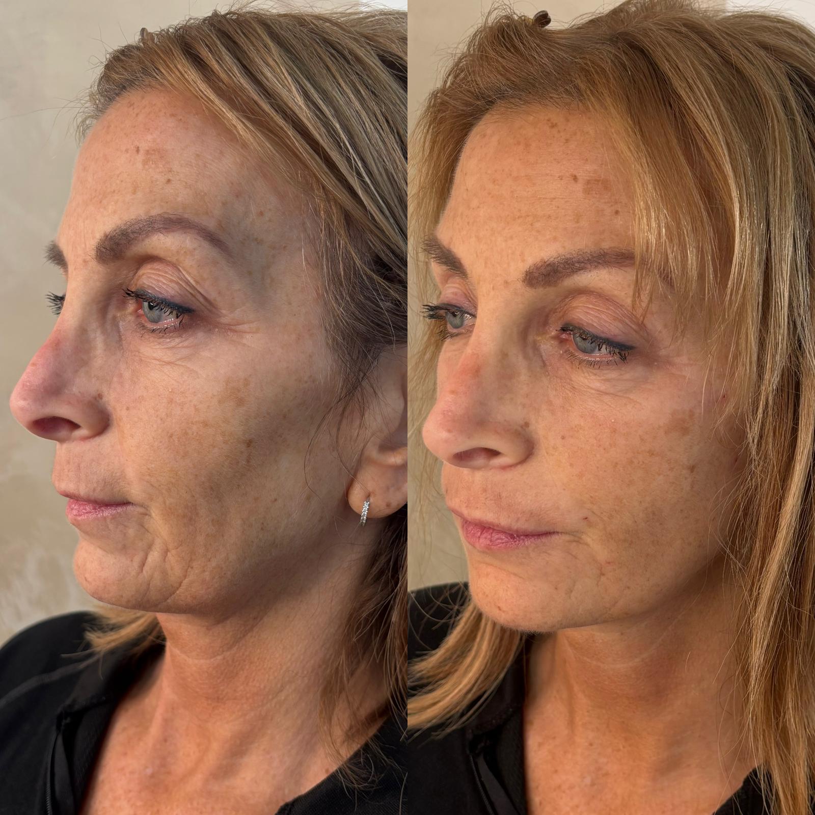 Full Face Lift — before and after Endolift