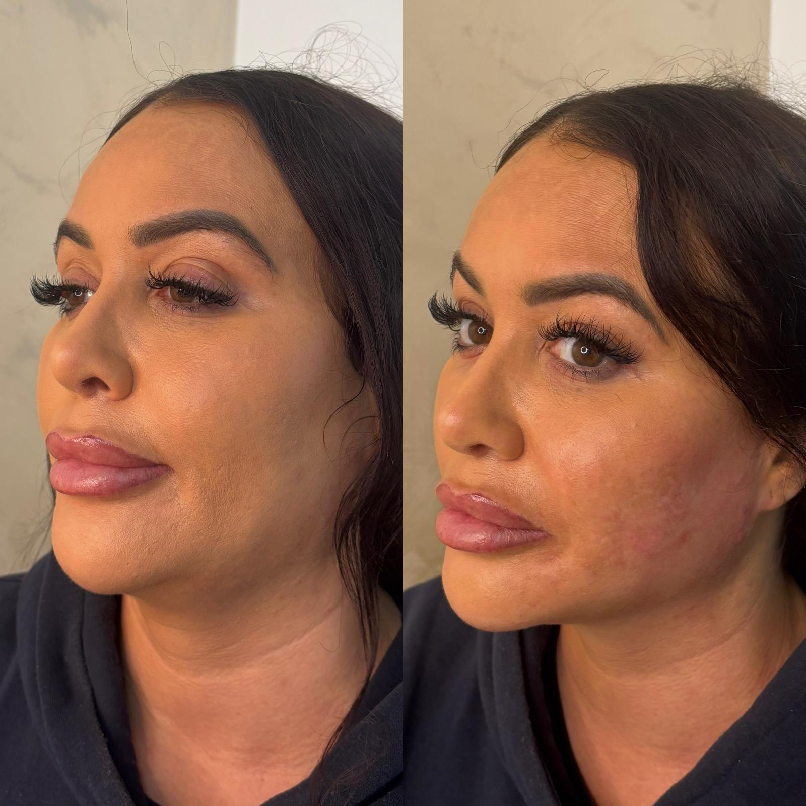 Full Face Lift — before and after Endolift