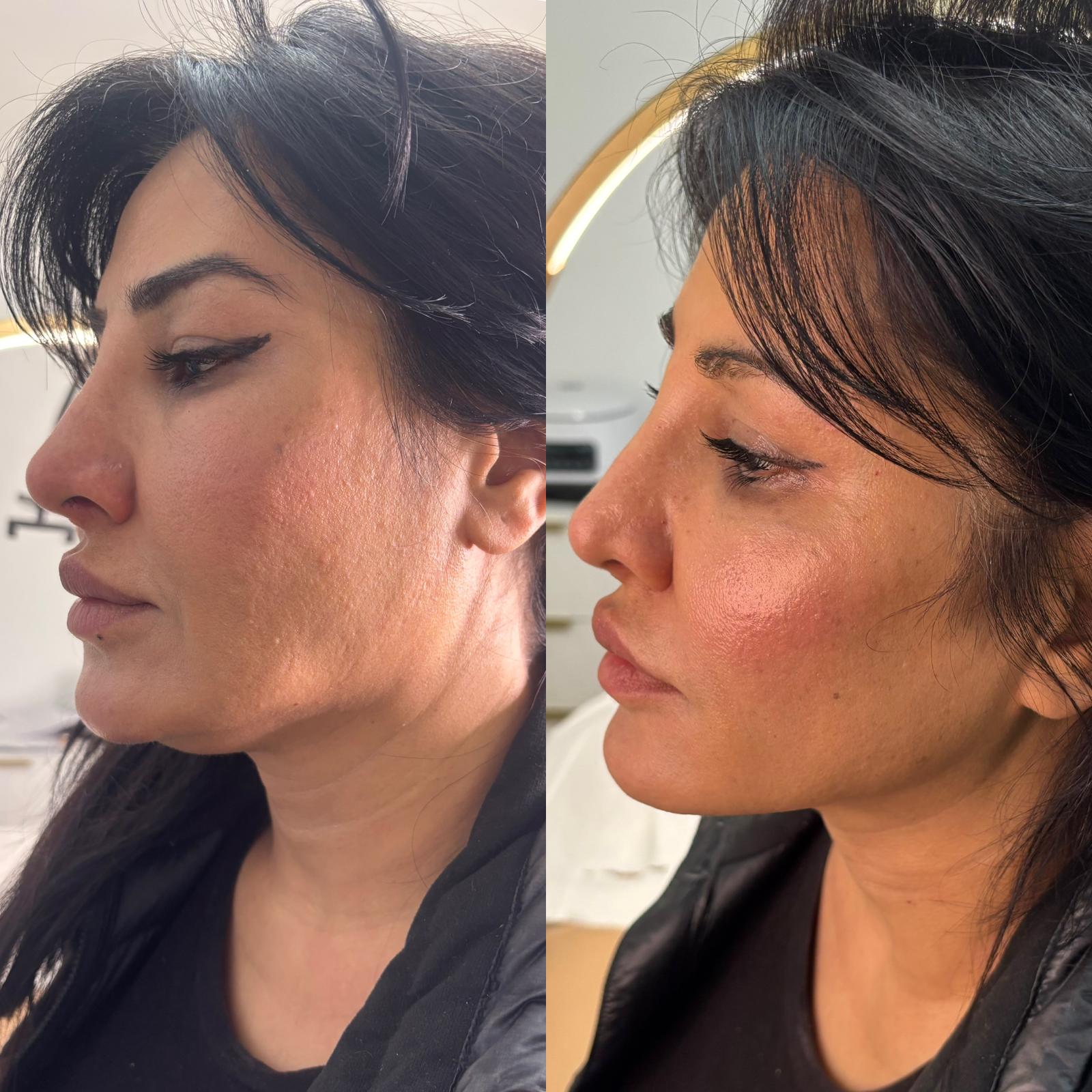 Full Face Lift — before and after Endolift