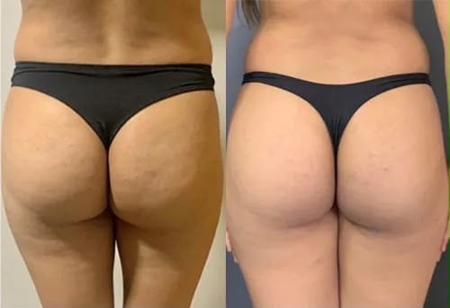 Thighs/Buttocks Lift — before and after Endolift
